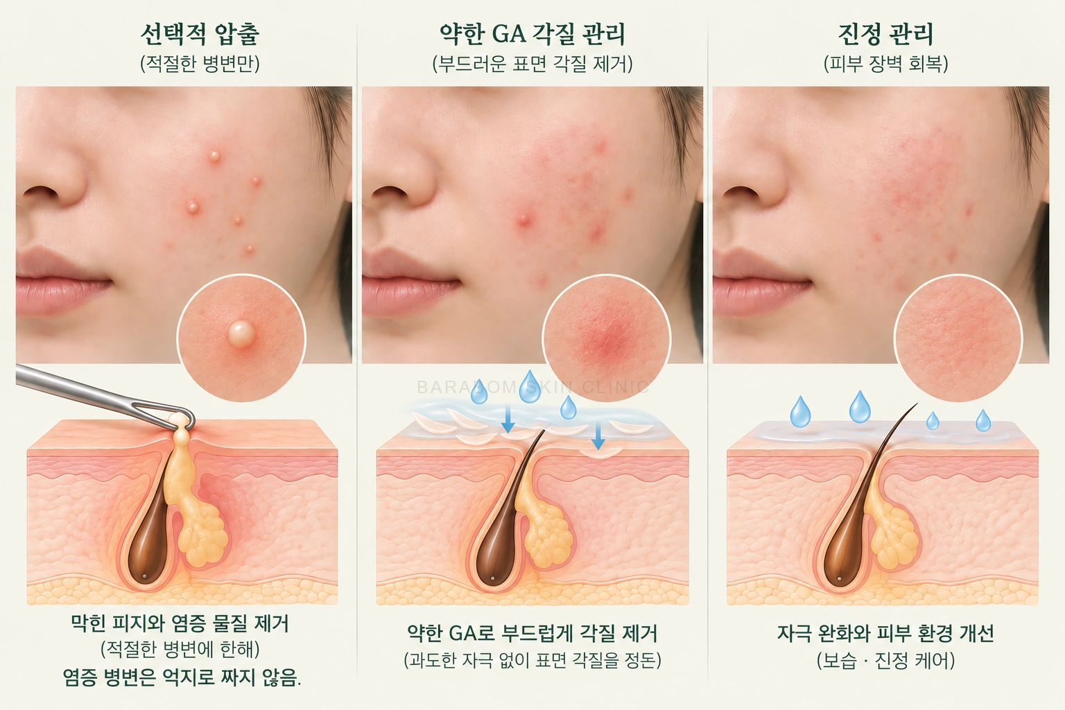 피지와 각질이 모낭 입구에 쌓이는 모습을 설명한 그림