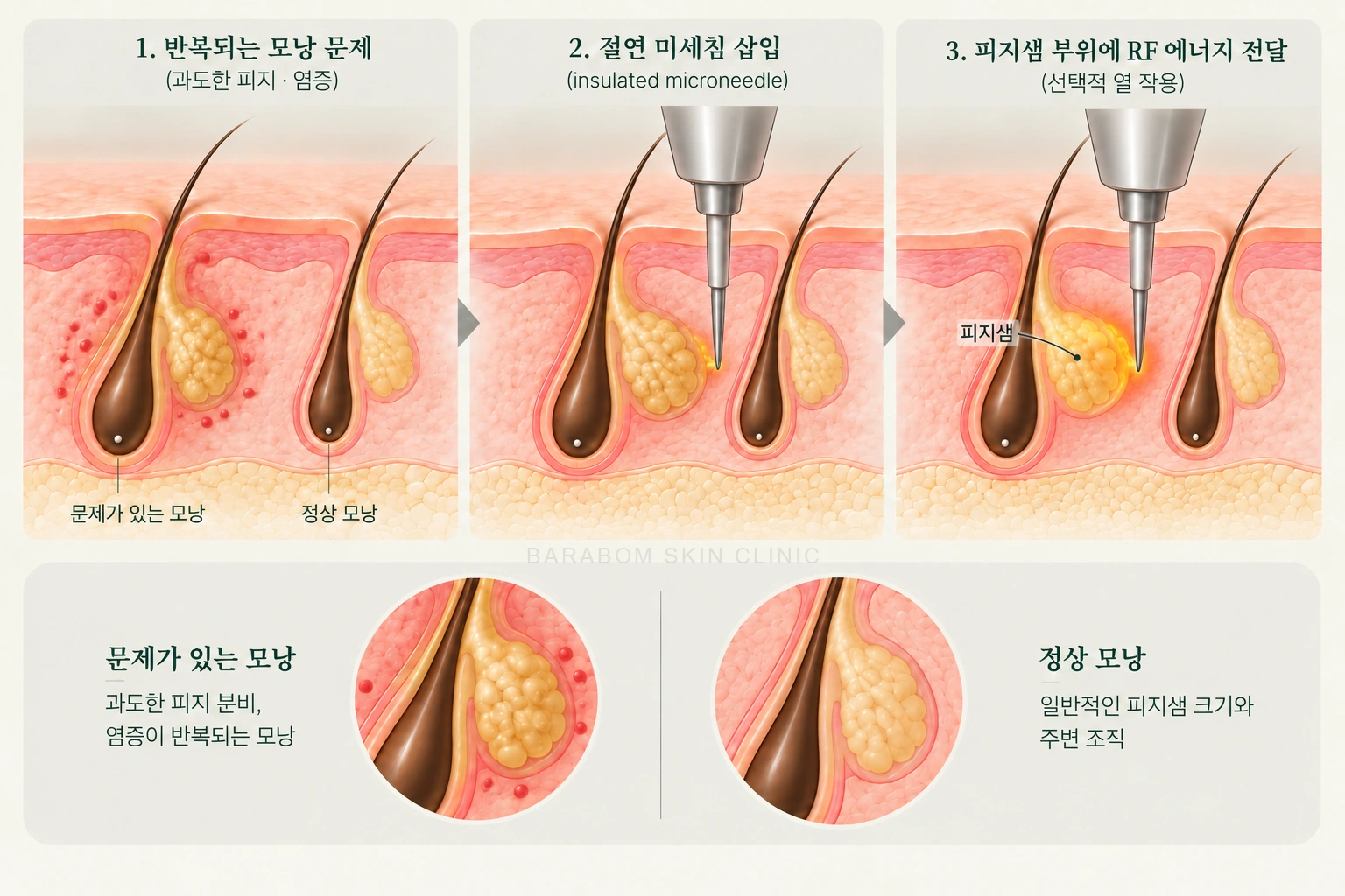 모낭 주변 구조와 아그네스의 치료 대상을 설명한 그림