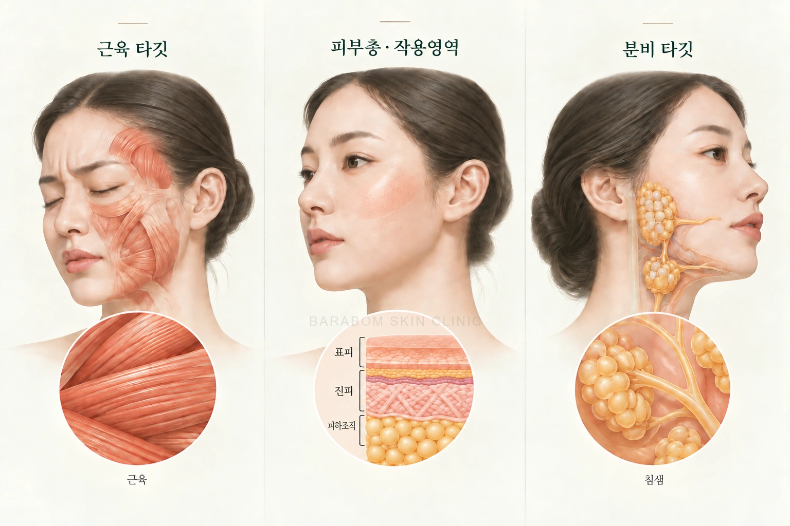 근육, 피부, 분비 기능의 서로 다른 보톡스 치료 대상을 설명한 그림