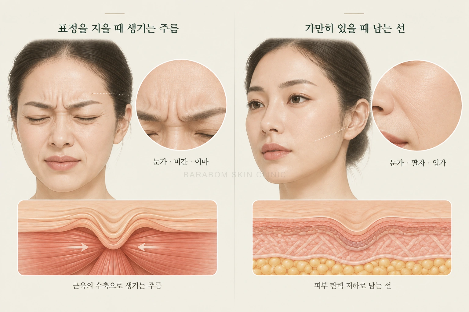 표정에 따라 보이는 얼굴 주름을 비교한 그림