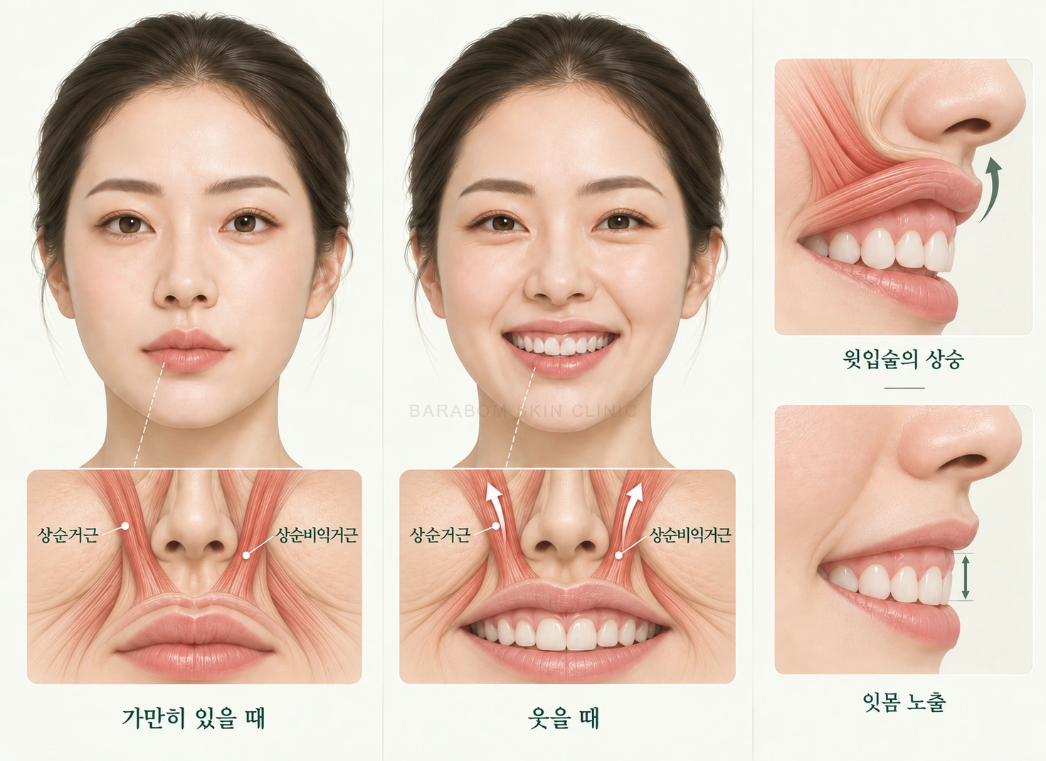 웃을 때 윗입술 움직임과 잇몸 노출의 관계를 설명한 그림