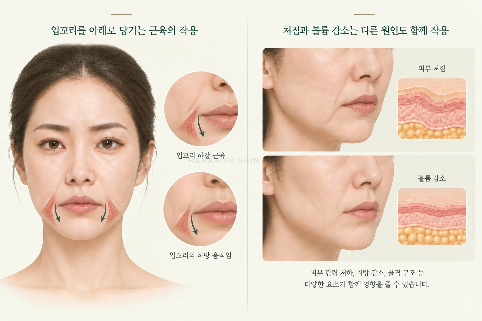 입꼬리 주변 근육의 당김과 처짐·볼륨 차이를 비교한 그림