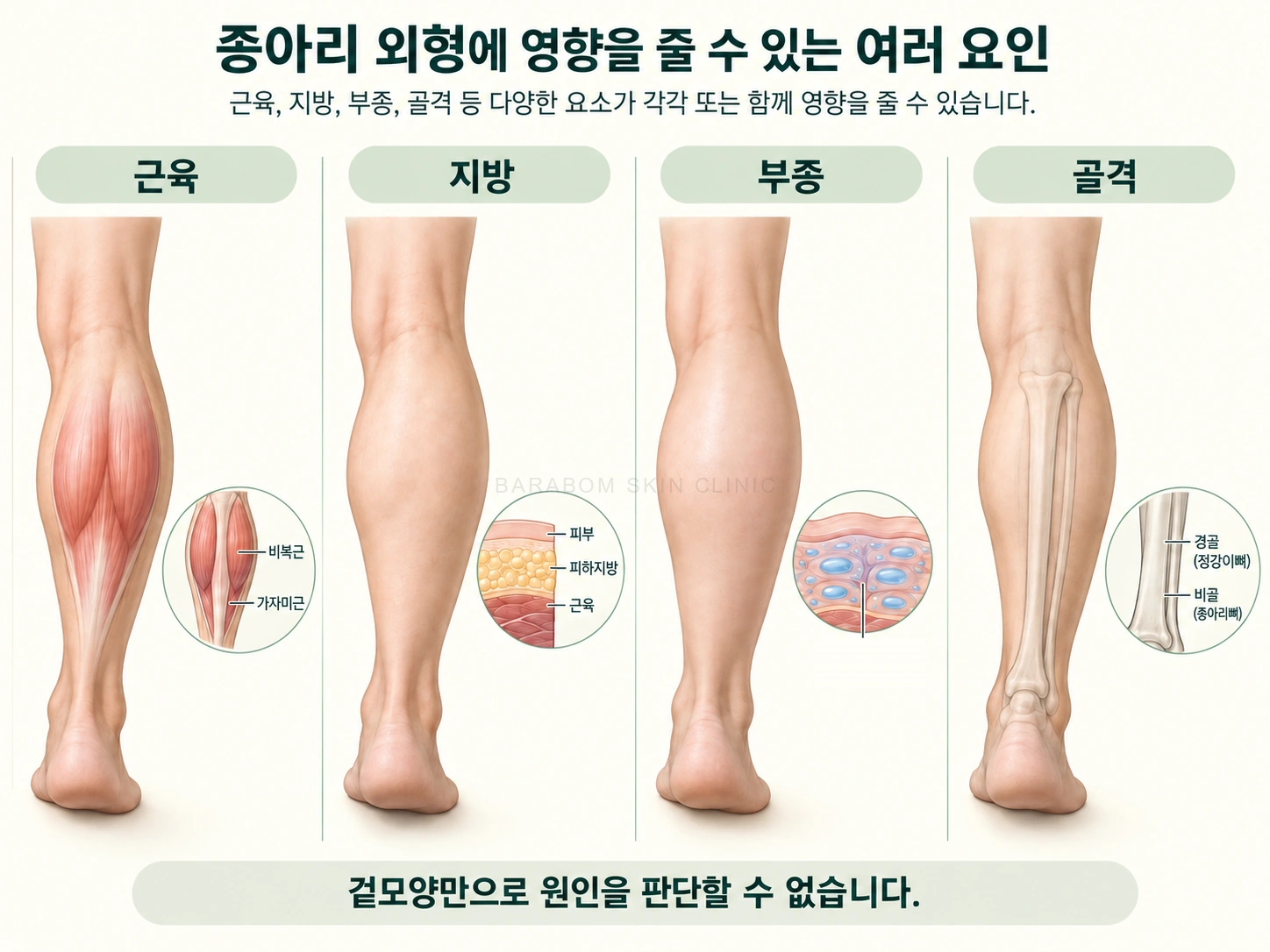 종아리 윤곽에 영향을 주는 근육, 지방, 부종, 골격을 구분한 그림