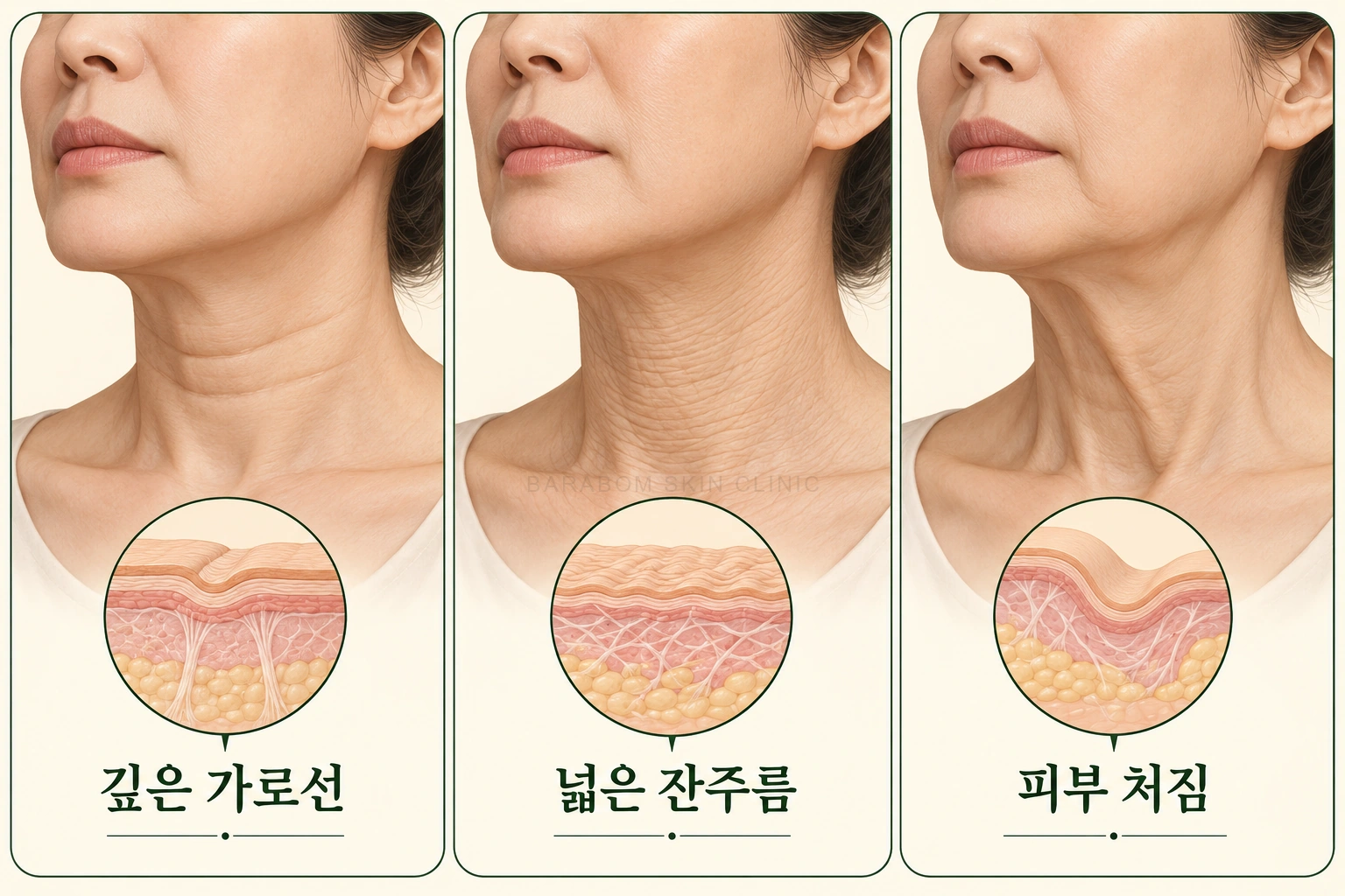 목의 가로선과 잔주름, 피부 처짐을 비교한 그림
