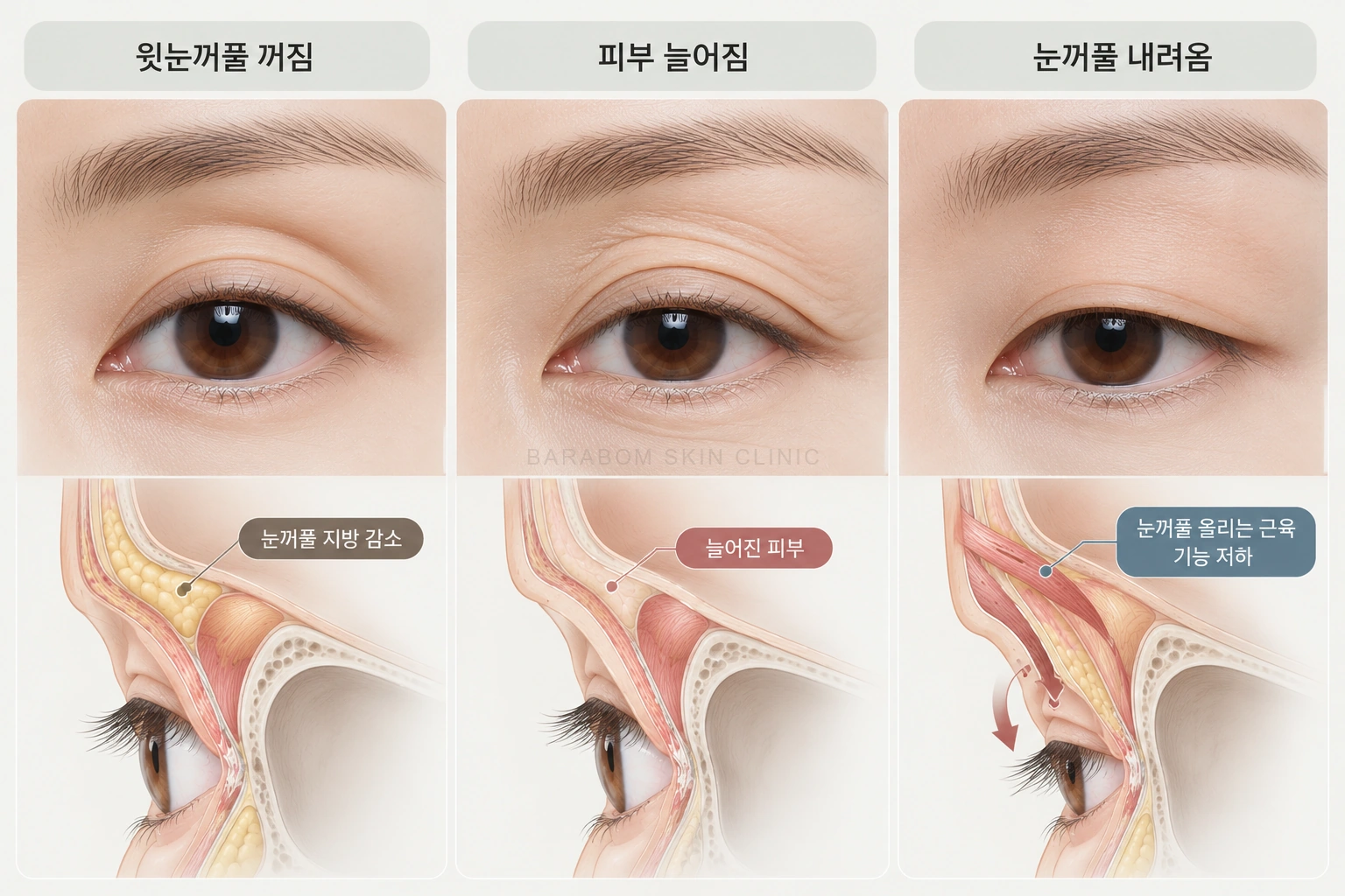 윗눈꺼풀의 꺼짐과 처짐을 구분한 그림
