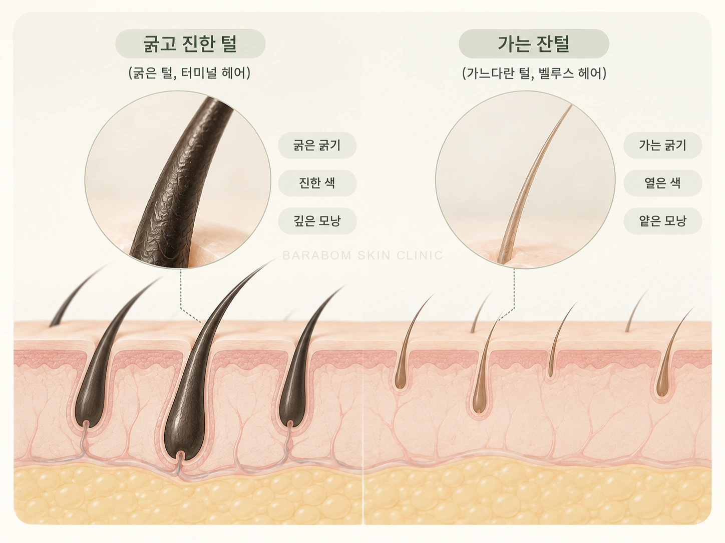 굵고 진한 털과 가는 잔털의 차이를 설명한 그림