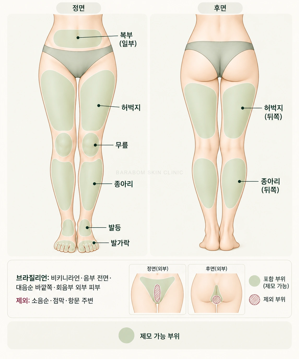 여성 하체 제모 범위를 구분한 그림