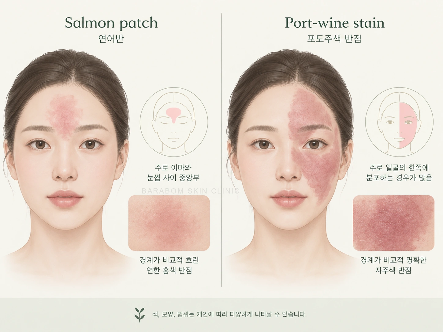 연어반과 화염상모반의 특징을 비교한 그림