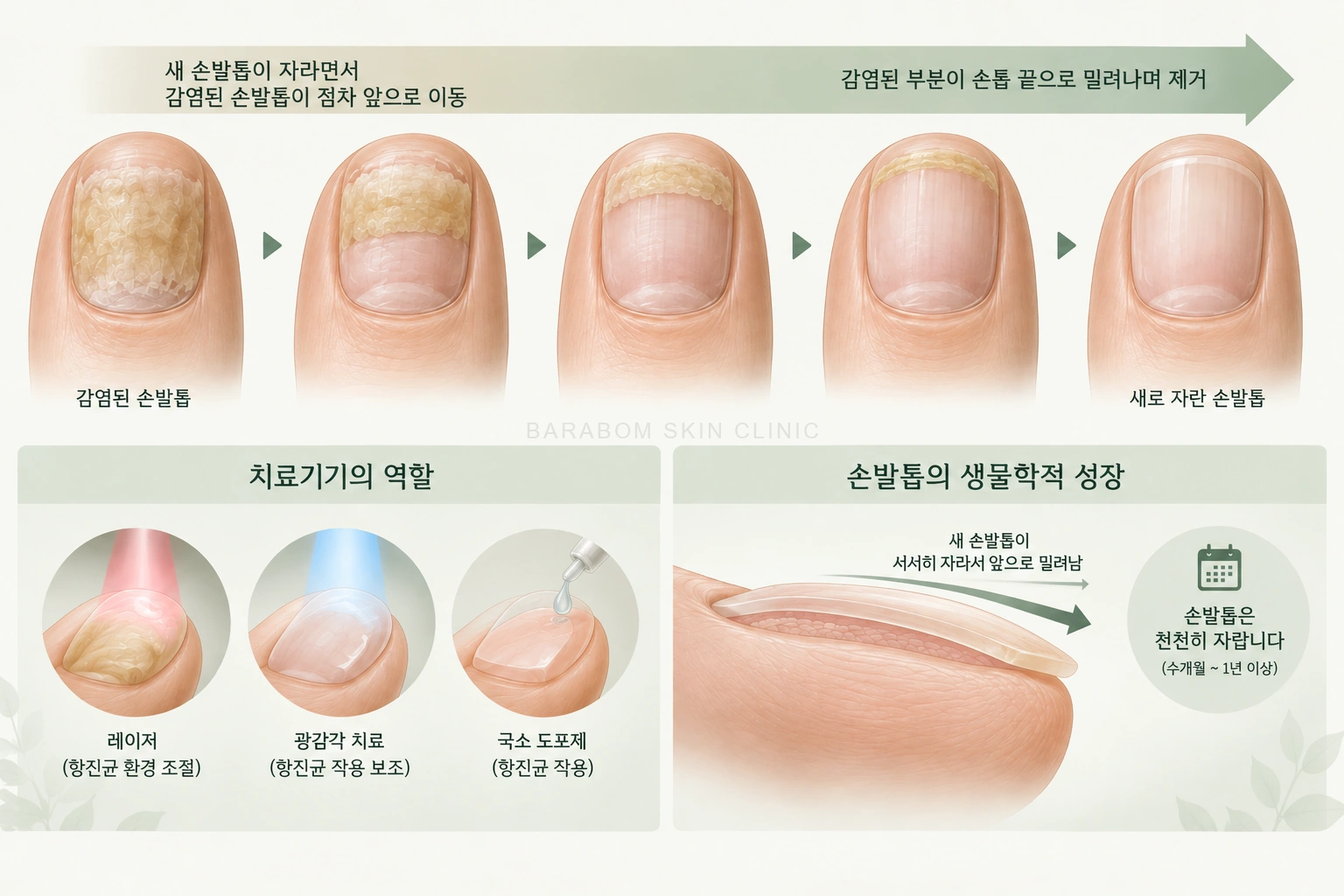 발톱이 자라면서 손상된 부분이 이동하는 과정을 설명한 그림