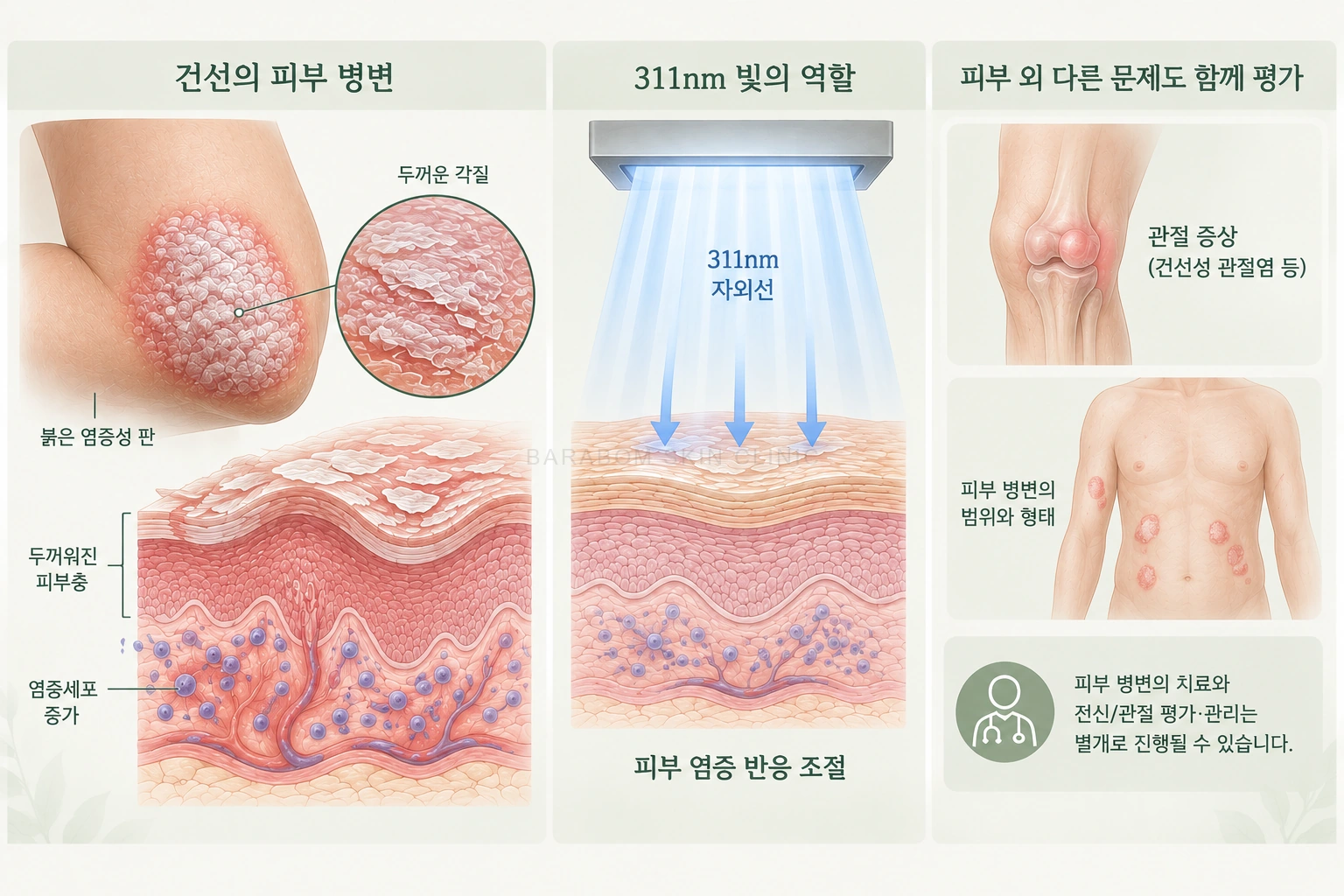 건선 병변과 국소 광선치료의 역할을 설명한 그림