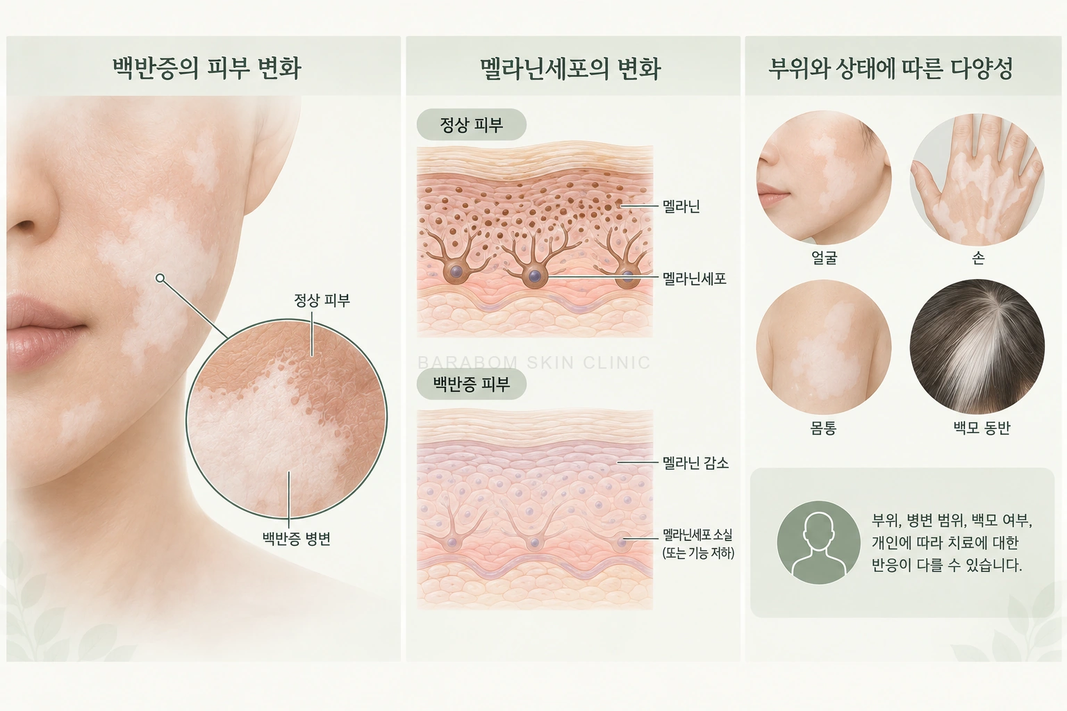 백반증의 부위별 색소세포와 반응 차이를 설명한 그림
