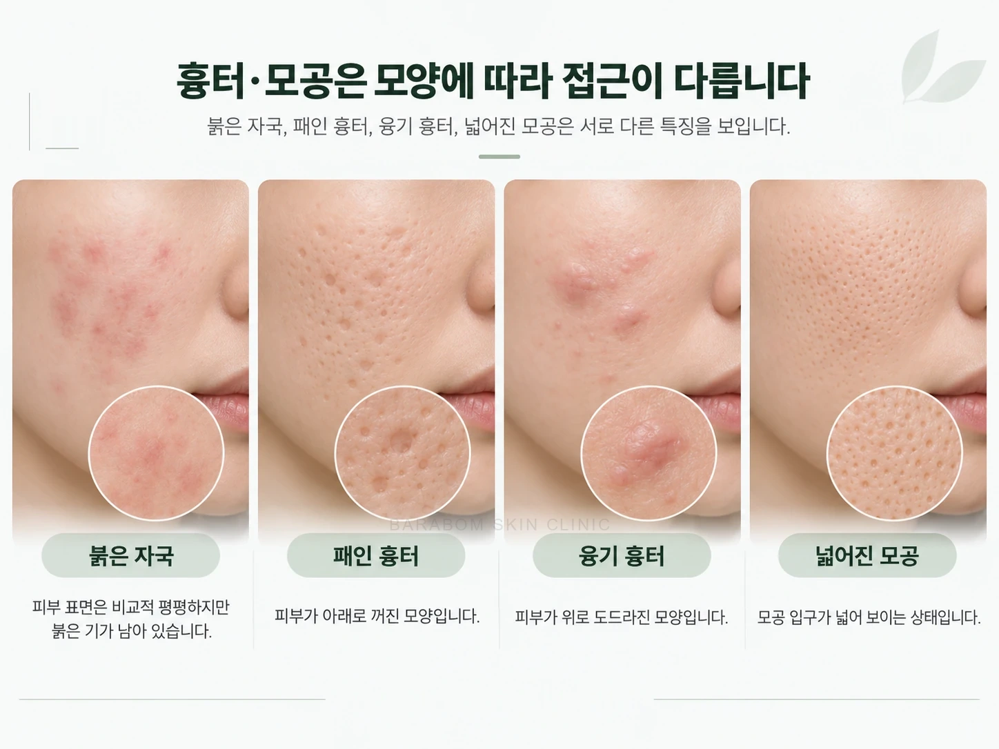 붉은 자국, 패인 흉터, 융기 흉터와 넓어진 모공을 나란히 보여주는 설명 그림