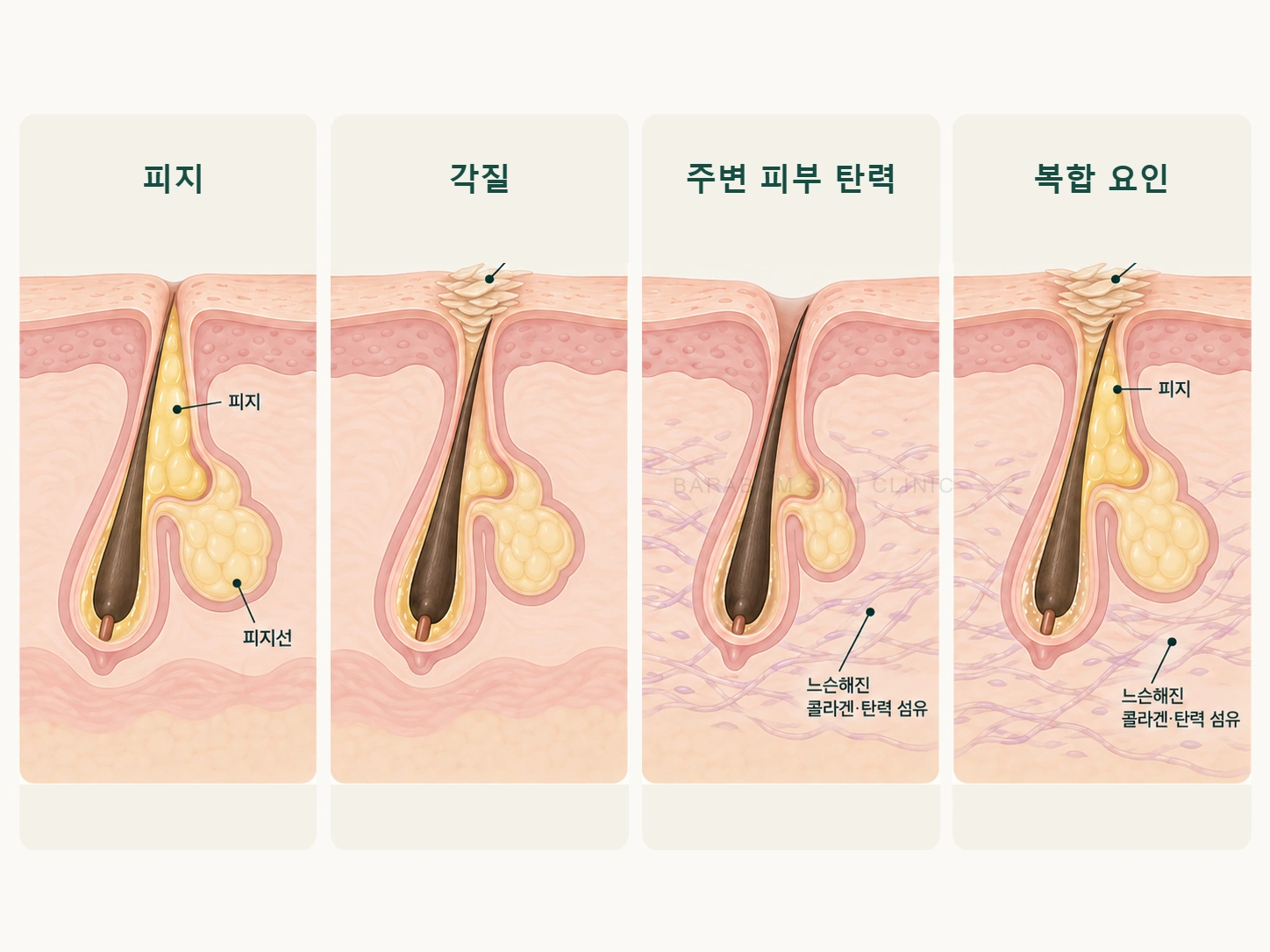모공에 영향을 주는 피지와 각질, 탄력 요인을 설명한 그림