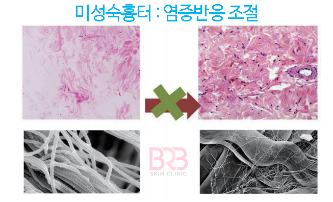 왼쪽 사진 : 미성숙흉터/오른쪽 사진 : 성숙흉터