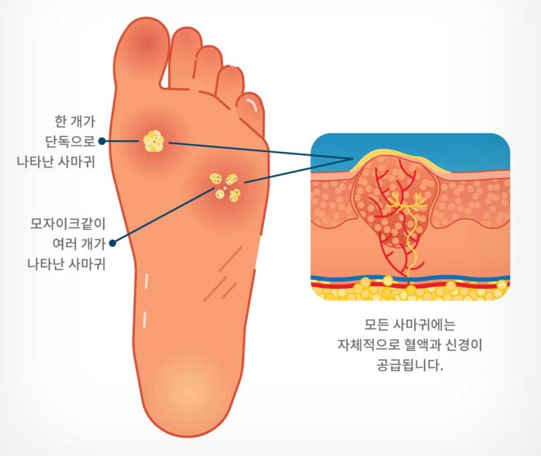 손발바닥사마귀-발병양상