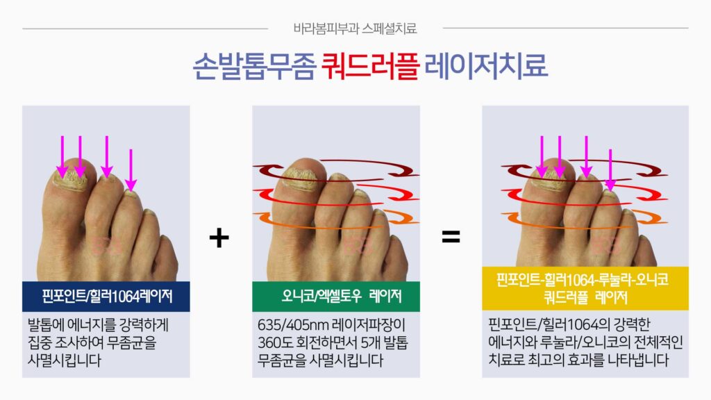 손발톱무좀쿼드러플레이저치료