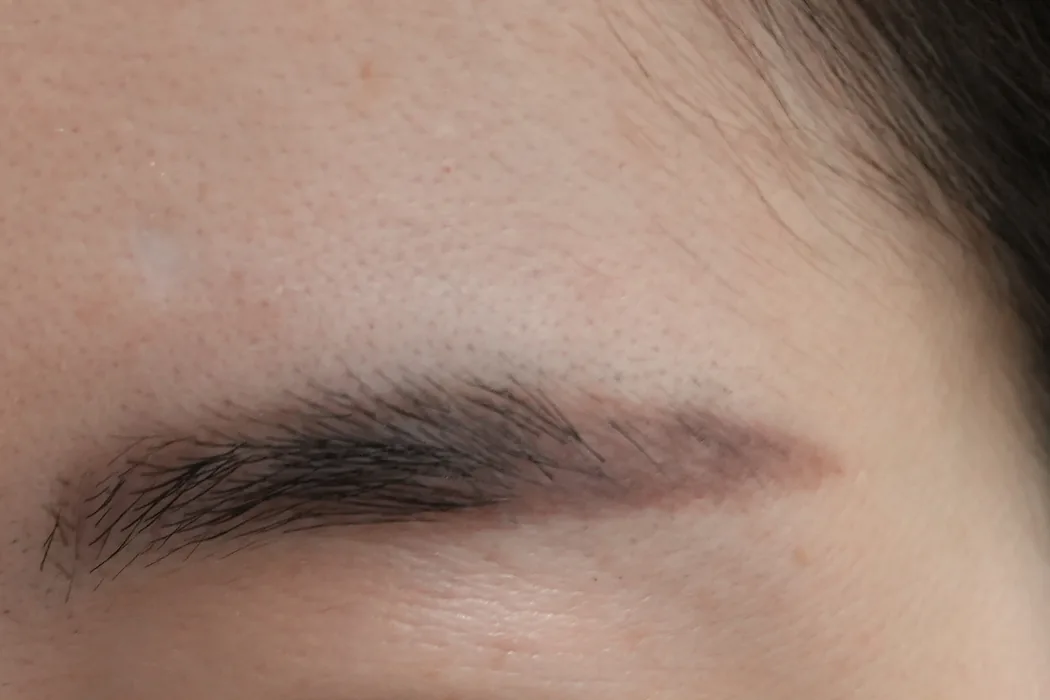한쪽 눈썹을 따라 들어간 반영구 색소. 눈썹 꼬리 쪽 털이 없는 부분까지 갈색 색소가 보인다