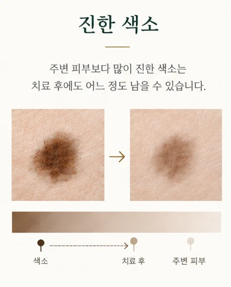 진한 색소: 주변 피부보다 많이 진한 색소는 치료 후에도 어느 정도 남을 수 있다.