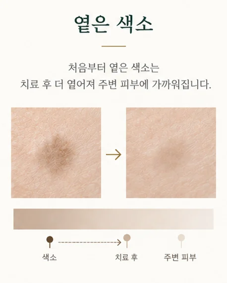 옅은 색소: 처음부터 옅은 색소는 치료 후 더 옅어져 주변 피부에 가까워진다.