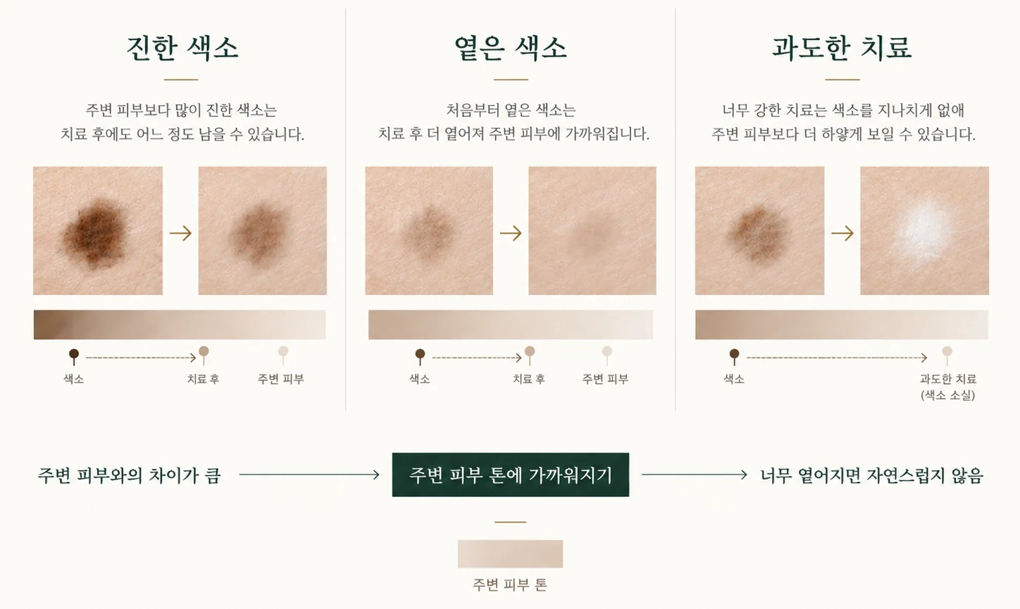 색소치료 목표 개념도. 진한 색소는 치료 후에도 어느 정도 남을 수 있고, 처음부터 옅은 색소는 치료 후 더 옅어져 주변 피부에 가까워지며, 너무 강한 치료는 색소를 지나치게 없애 주변 피부보다 하얗게 보일 수 있다. 목표는 주변 피부 톤에 가까워지는 것이다.