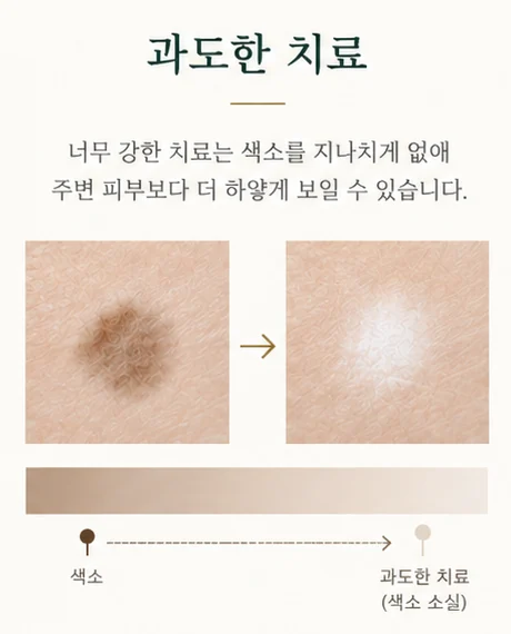 과도한 치료: 너무 강한 치료는 색소를 지나치게 없애 주변 피부보다 하얗게 보일 수 있다.