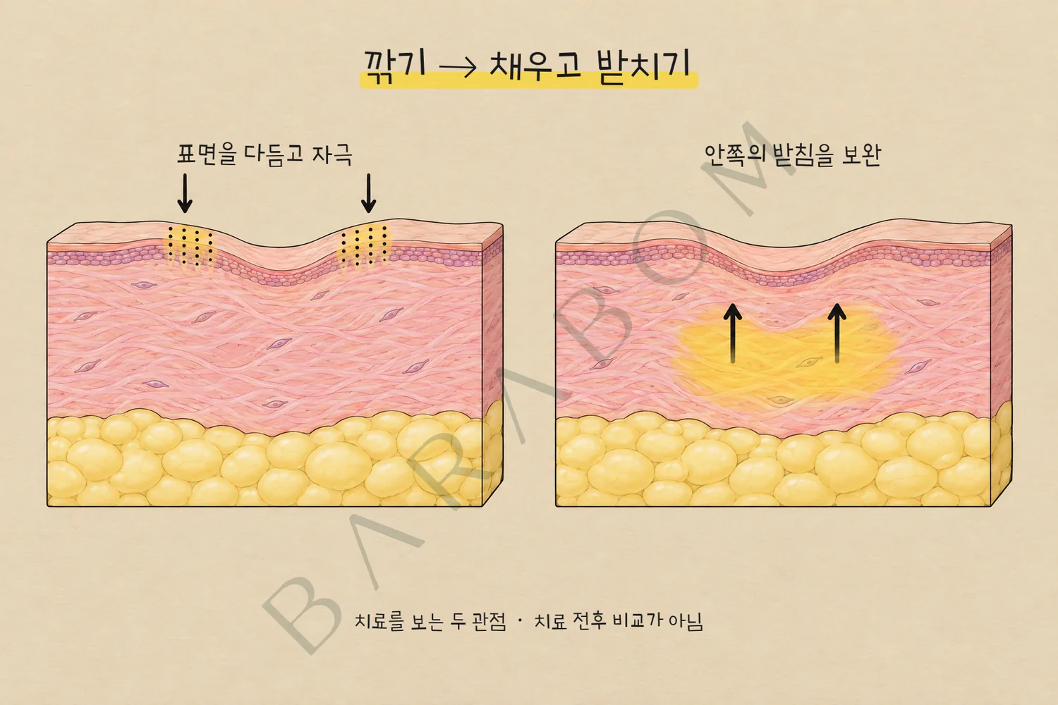 표면을 다듬는 아래 방향 화살표와 안쪽 받침을 보완하는 위 방향 화살표를 비교한 피부 단면 개념도. 깎기에서 채우고 받치기로 치료를 보는 순서의 변화.