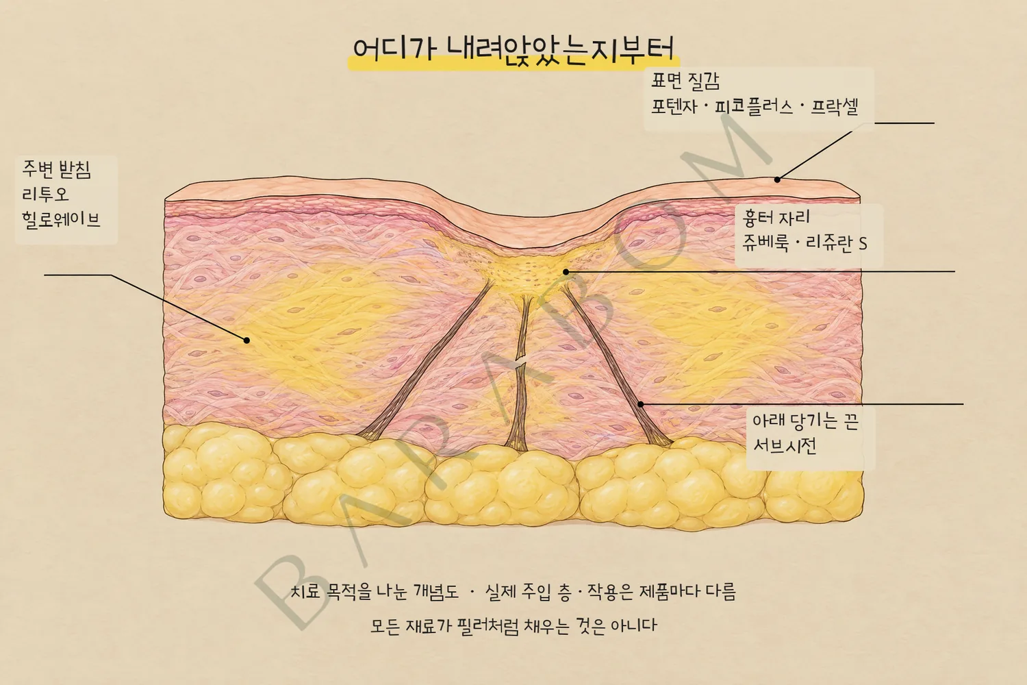 주변 받침 리투오·힐로웨이브, 국소 흉터 쥬베룩·리쥬란 S, 아래 유착의 서브시전, 표면 질감의 포텐자·피코플러스·프락셀을 나눈 피부 단면 개념도.