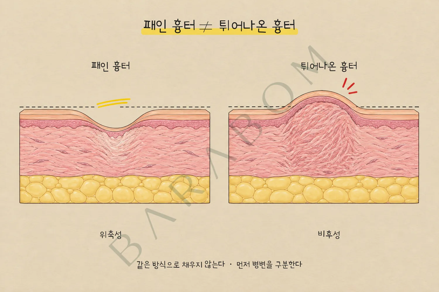정상 피부면보다 내려앉은 위축성 흉터와 올라온 비후성 흉터의 단면 비교. 두 유형은 먼저 구분해야 한다.
